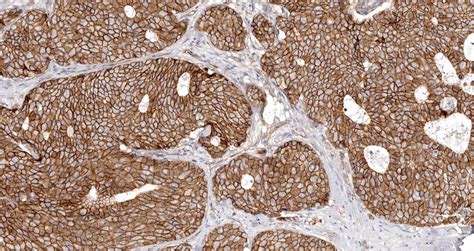 beta-catenin|Pathology Outlines .